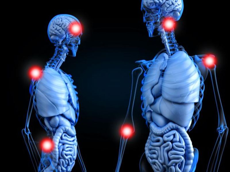 Artritis reumatoidea: Diagnóstico y tratamiento