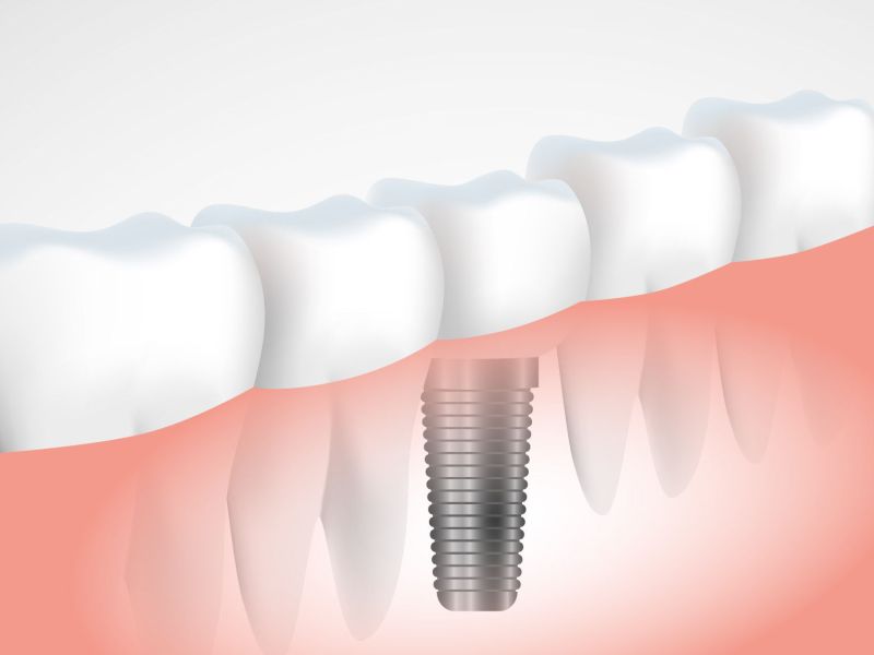 Implantes dentales