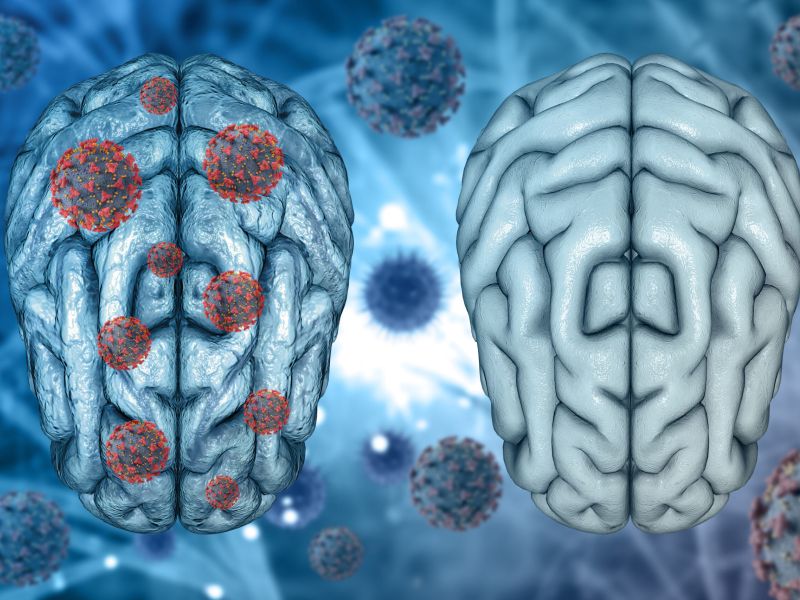 La COVID 19 podría aumentar el riesgo de sufrir enfermedades neurodegenerativas