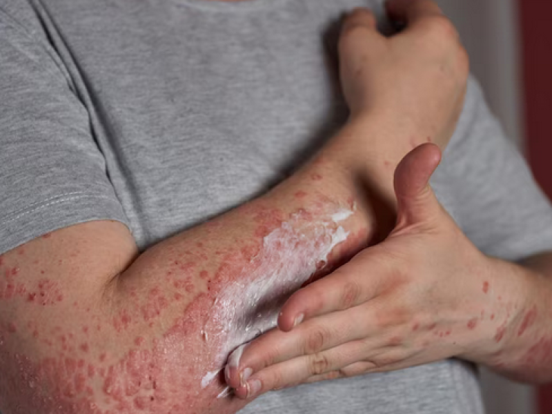 Bacteriófagos: Una nueva estrategia de tratamiento para dermatitis atópica