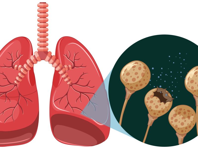 Tuberculosis 2021: Panorama en Colombia