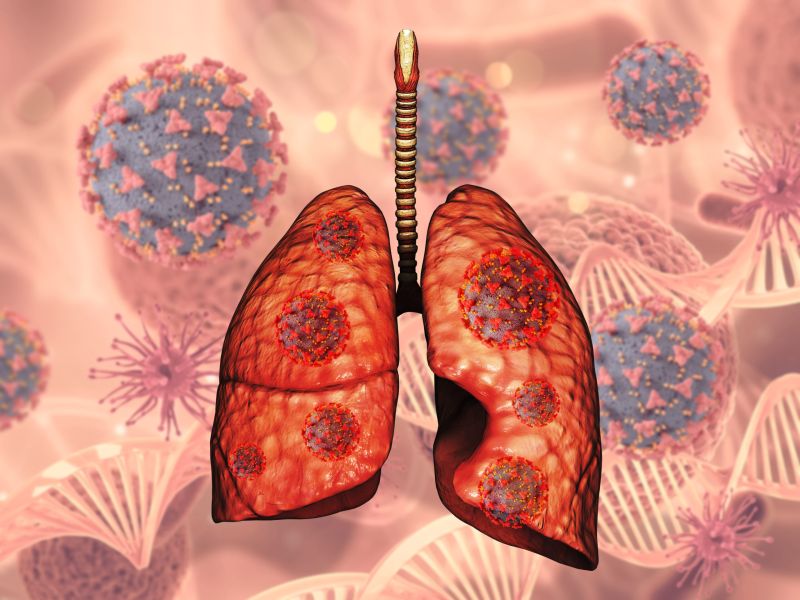 Embolismo pulmonar