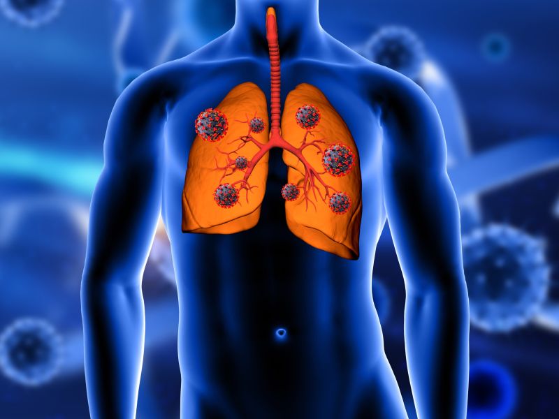 COVID – 19: Impacto en el control de la tuberculosis