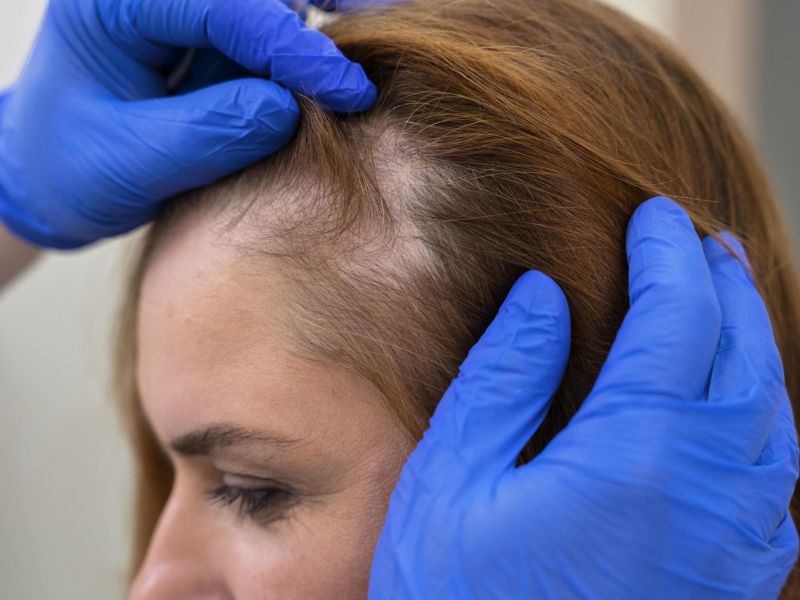 Primer tratamiento aprobado por la FDA para la alopecia de origen autoinmunes
