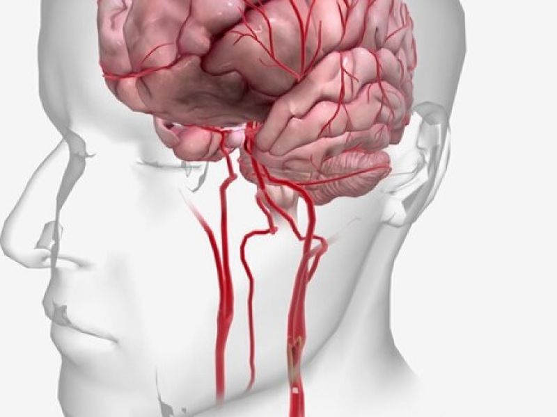 Centro de accidentes cerebrovasculares más cercano, la mejor opción para tratar una hemorragia intracerebral..