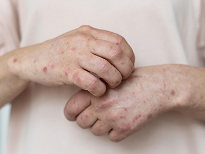 Avances en diagnóstico y tratamiento del Lupus Eritematoso Sistémico